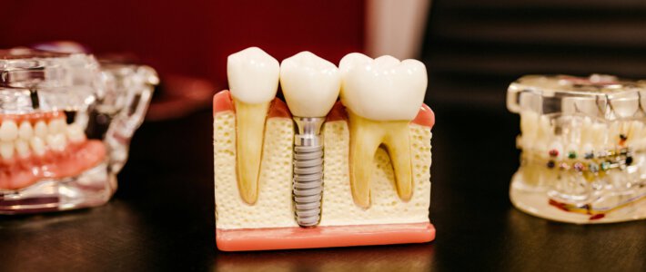 Zahnimplantate